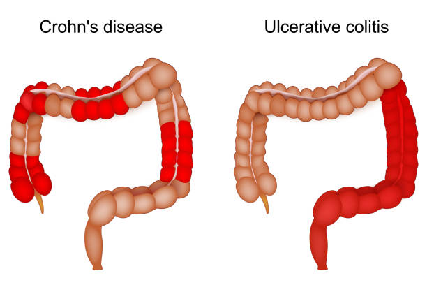 10 Informações Que Você Precisa Saber Se Tem Espondiloartrite 7 doenca infl intestinal espondiloartrites,Espondiloartrite
