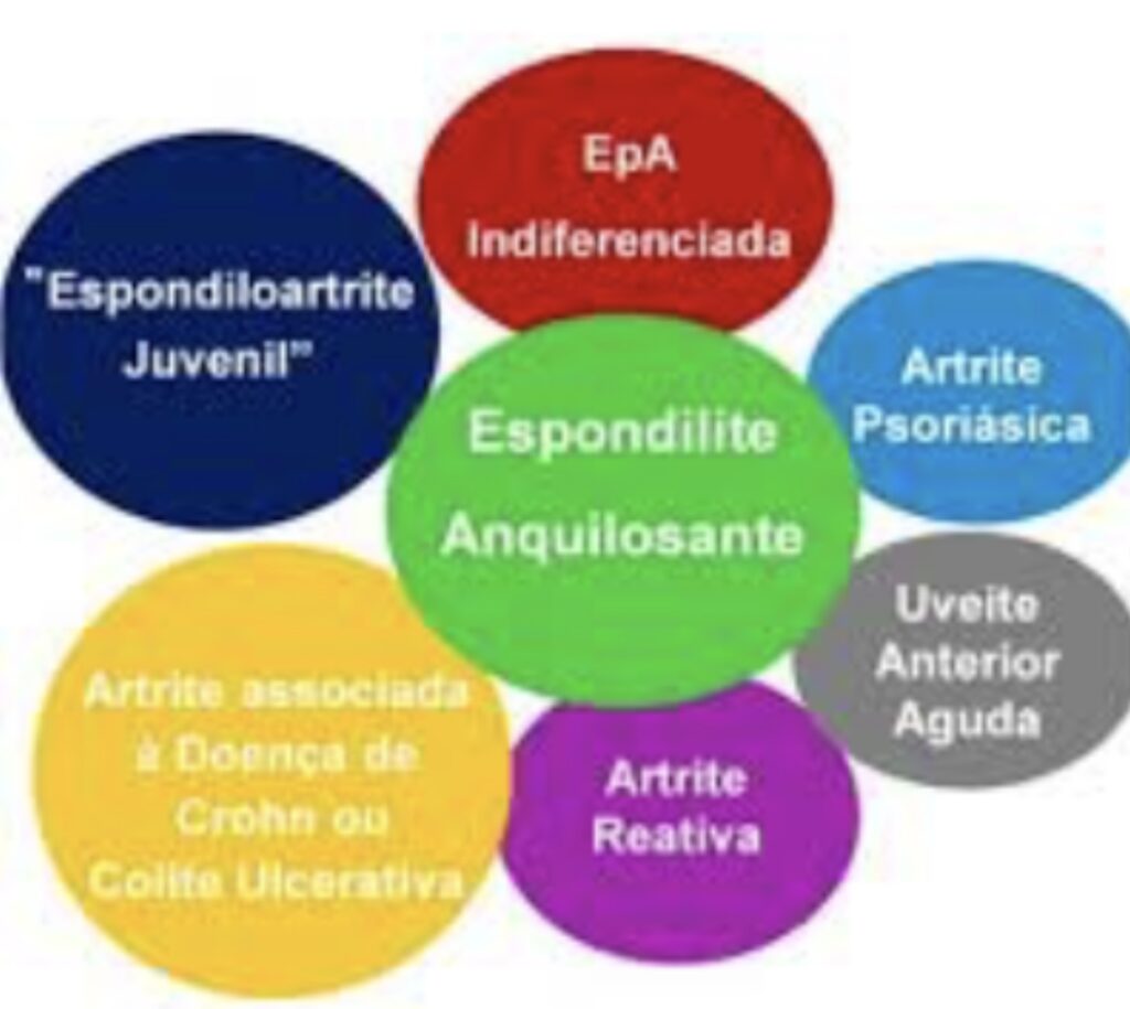 10 Informações Que Você Precisa Saber Se Tem Espondiloartrite 1 Espondiloartrites