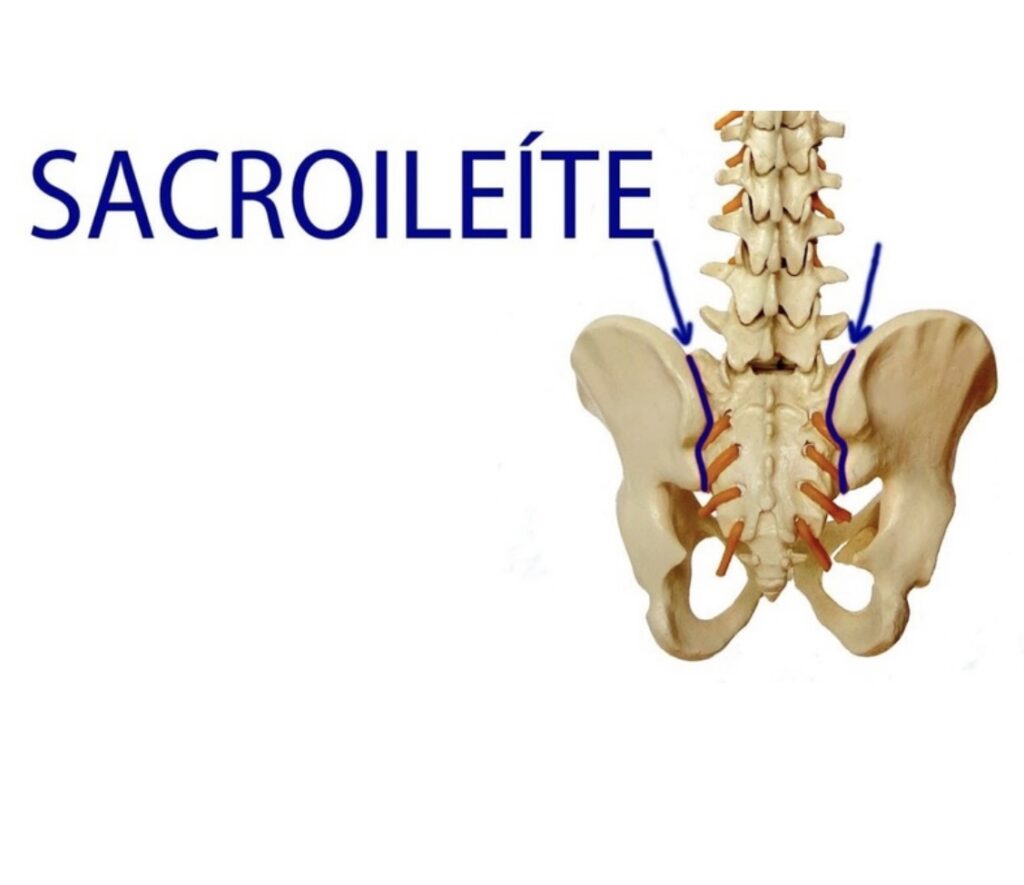 10 Informações Que Você Precisa Saber Se Tem Espondiloartrite 5 sacroiliite espondiloartrites,Espondiloartrite