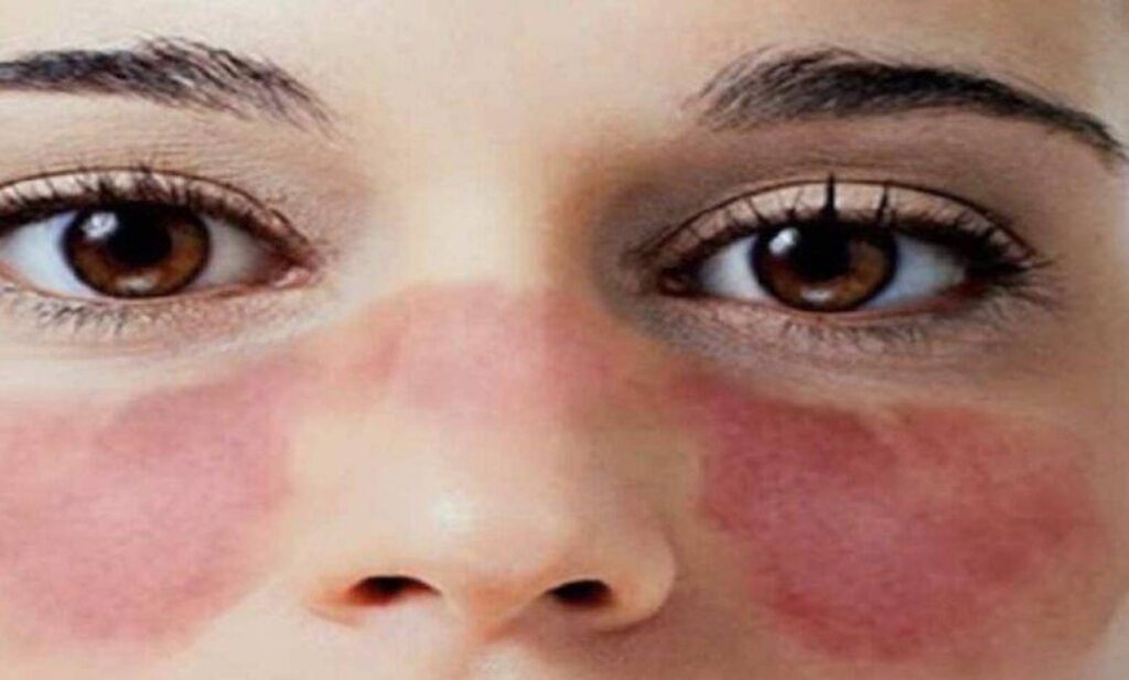 asa de borboleta lúpus eritematoso sistêmico,lupus