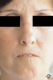 facies esclerodermica esclerose sistêmica,esclerodermia