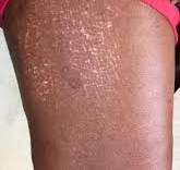 leucomelanodermia esclerose sistêmica,esclerodermia