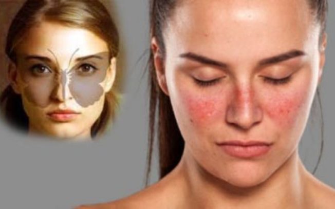 lupus lúpus eritematoso sistêmico,lupus