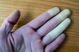raynaud esclerose sistêmica,esclerodermia