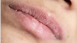 boca seca Doença de Sjogren