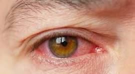 olho seco Doença de Sjogren